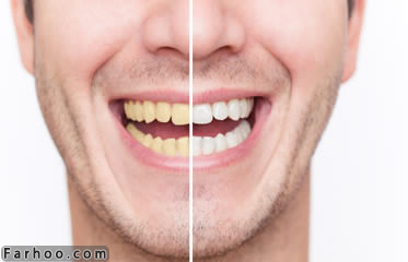 راه های ساده سفید کردن دندان‌ در خانه