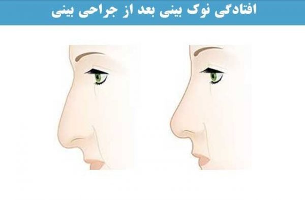 علل افتادگی بینی بعد از جراحی زیبایی