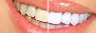 جرم گیری دندان با پوست گردو و سایر روش‌های طبیعی
