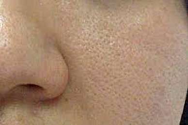 درمان های طب سنتی برای بستن منافذ پوست