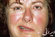 فلج صورت،زخم پشت پلک،کچلی صورت و سر ، و علائم قرمز چشم و صورت به چه علت است؟
