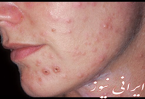 زخم صورت و پوست مرتبط با چه نوع ویروسی است و راه درمان آنها چیست؟