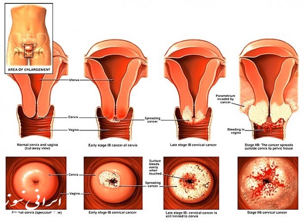 سرطان واژن زنان، علت بروز آن