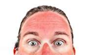 درمان آفتاب سوختگی پوست