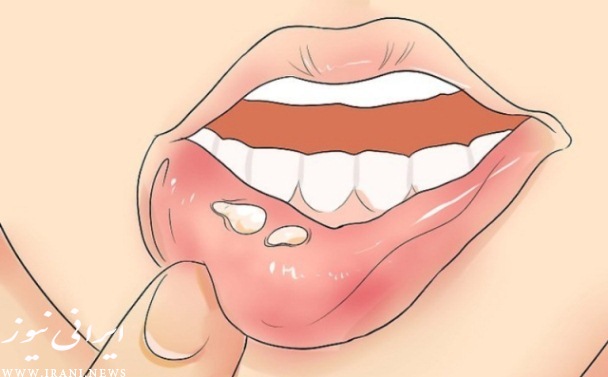 درمان جوش های داخل دهان در طب سنتی