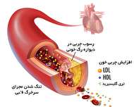 چربی خون یک عامل خطر زای نامرئی