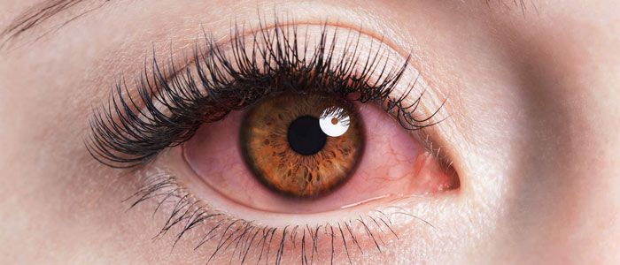 بیماری چشم صورتی؛ علت، تشخیص و راه درمان
