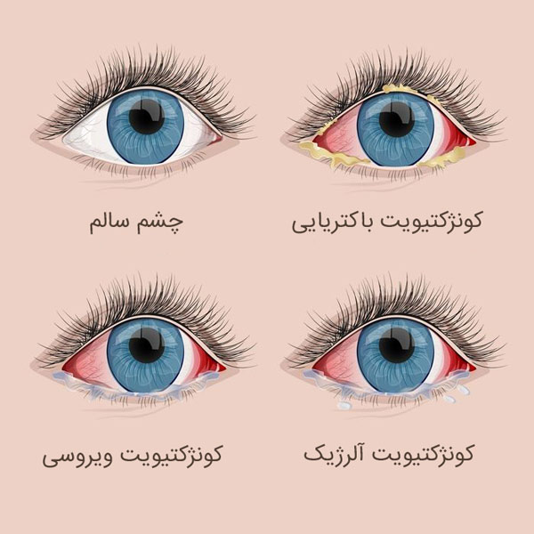 عکس انواع بیماری چشم صورتی