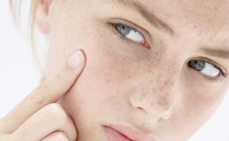 درمان خشکی پوست treatment-for-dry-skin-acne
