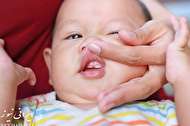 علل، علائم و درمان لیپوساکشن در نوزادان
