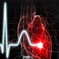 علت ۳۰ درصد سکته های مغزی ناشی از نامنظمی های ضربان قلب است