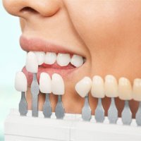 کامپوزیت و لمینت چه بلایی بر سر دندان ها می آورد؟