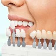 عوارض استفاده از کامپوزیت و لمینت برای دندان