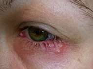 ویروس هرپس سیمپلکس باعث تبخال چشمی میشود