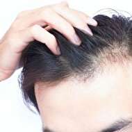 ریزش مو تیپ مردانه را نمی‌توان یک بیماری محسوب نمود.