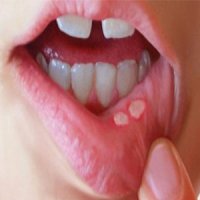 علل و راه‌های درمان آفت دهان