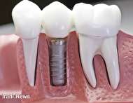 تاج دندان یا ایمپلنت، کدام یک بهترین انتخاب برای شما است؟