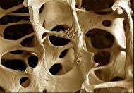 درمان پوکی استخوان با ۱۵ روش ساده و مناسب