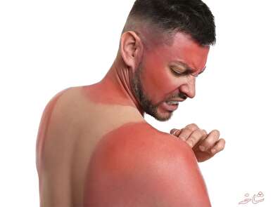 آفتاب سوختگی را به آسانی درمان کنید